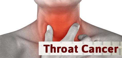 Symptoms Of Throat Cancer