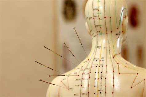 Akupunktur Nach Traditioneller Chinesischer Medizin