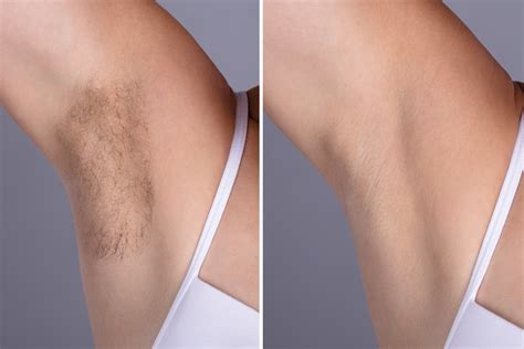 Does home laser hair removal work? Cheap Laser Hair Removal San Diego