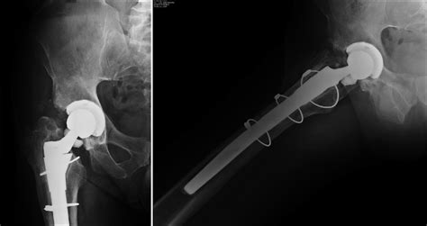 Anteroposterior A And Lateral B Radiographs At Presentation