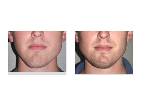 Jaw Asymmetry Correction Archives