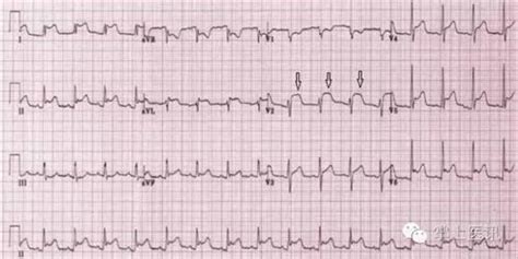 心肌坏死的心电图特征性表现是 A ST段弓背抬高B 病理性Q波C T波_第二人生