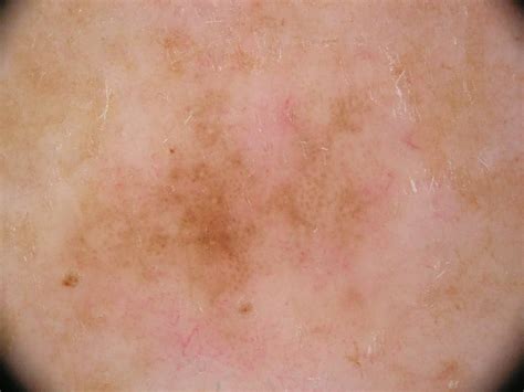 Early Signs Of Skin Cancer On Back