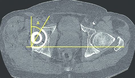 Anatomical Cup Anteversion Using Ct Imaging Kim Et Al 2009 A