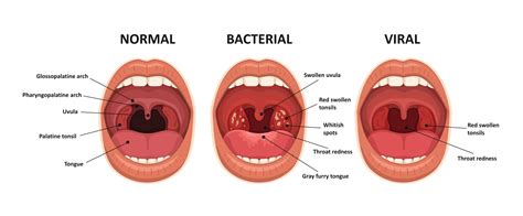 What Are The Common Causes Of Strep Throat Le Bistro Du Parc