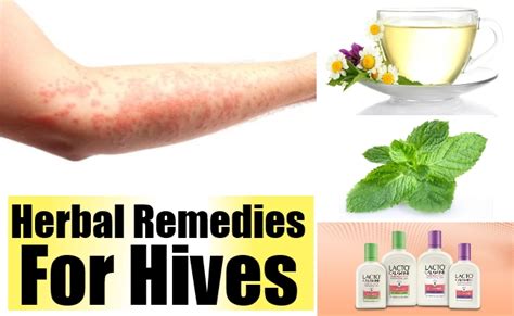 Herbal Remedies For Hives Natural Home Remedies And Supplements