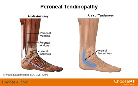 Guide Physical Therapy Guide To Peroneal Tendinopathy Choose Pt