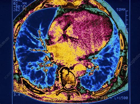 Asbestosis Ct Scan Stock Image M1080607 Science Photo Library