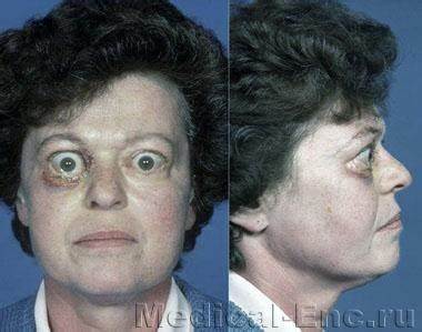 Зоб диета лечение Зоб диффузный токсический (базедова болезнь, тиреотоксикоз) симптомы Зоб диффузный токсический (базедова болезнь, тиреотоксикоз) симптомы Зоб диета лечение