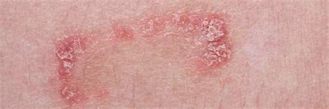 8 Things I Wish Id Known About Psoriasis Healthcentral