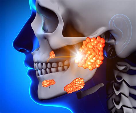 Mumps is a highly contagious viral infection that is transmitted via airborne droplets. Mumps: Symptoms, causes, and treatment