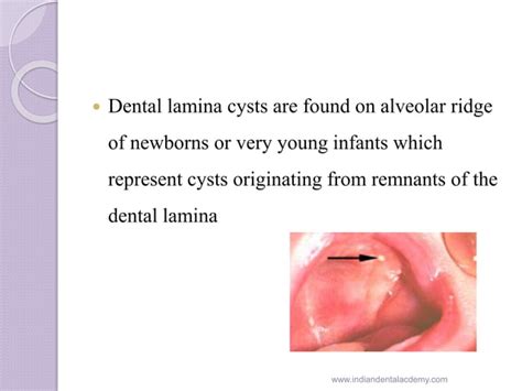 Gingival Cyst Of Newborn Orthodontic Courses By Indian Dental Academy