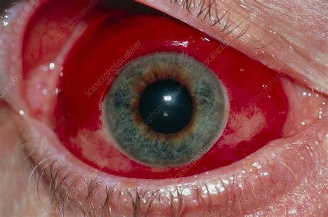 Close Up Of Eye Sub Conjunctival Haemorrhage Stock Image M1550186