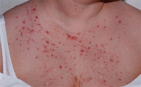 Red Spots On Chest Area Lwmups