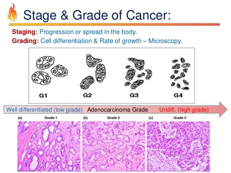 Cancer Staging And Grading Chart