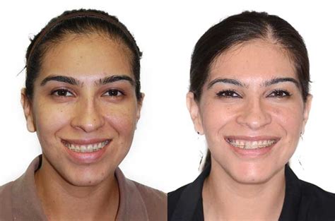 Face Asymmetry And Bite Correction Orthognathic Case Corrective Jaw