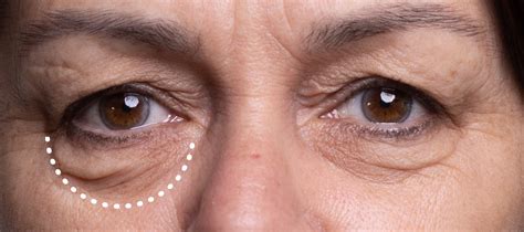 Are You Considering Eye Bag Removal Surgery First Find Out About Opt