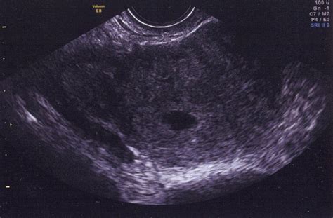 5 Week Pregnancy Ultrasound What To Expect In An Ultrasound