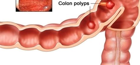 Colon Cancer Stages Early Detection Anatomy System Human Body Anatomy Diagram And Chart Images