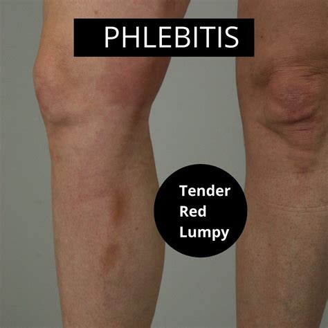 What Does Phlebitis Of The Leg Look Like With Pictures The
