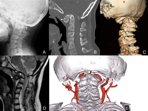 Preoperative Imaging Of The Craniovertebral Junction A Lateral