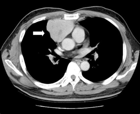 Chest Ct Showing An Anterior Mediastinal Tumor Approximately 69 ×55