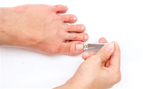 Blister Under Your Toenail Heres How To Treat It