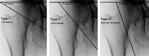 The Pauwels Classification For Intracapsular Hip Fractures Is It