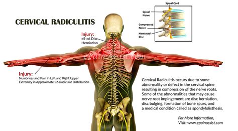Cervical Radiculitis Causes Symptoms Treatment Diagnosis