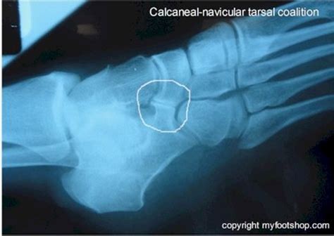 Tarsal Coalition Causes And Treatment Options