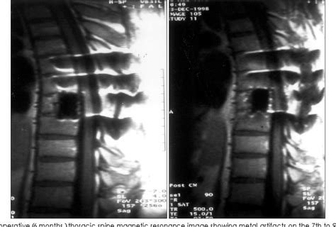 Pdf A Case Of Aneurysmal Bone Cyst On The Thoracic Spine A Case