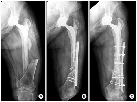 Treatment Of Periprosthetic Femoral Fractures In Hip Arthroplasty