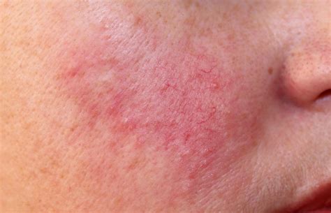 Rosacea Causes Symptoms And Treatments La Suite Skincare