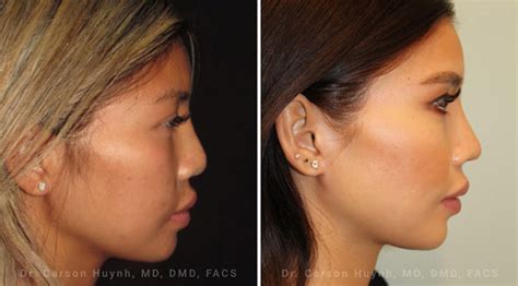 Wide Nose Rhinoplasty Asian