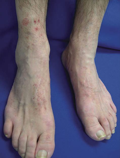 Erythematous Papules On The Legs—quiz Case Dermatology Jama