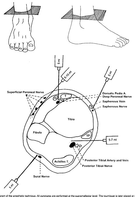 Figure 1 From Technique Tip Supramalleolar Ankle Block Anesthesia And