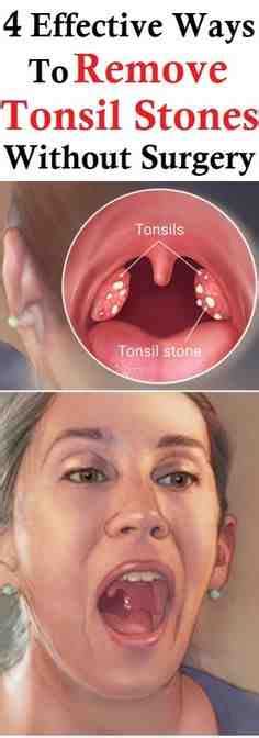 This may be related to difficulty swallowing food. Sore Throat Feels On Fire Tonsils Reasons Removed Your ...