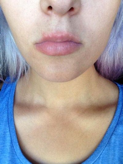 How Do I Fix The Small Pitted Acne Scars That Ruin My Upper Lip Line