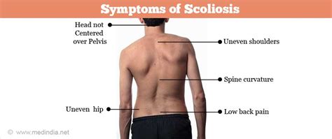 It is important to know the surface anatomy of various organs and viscera and their projections onto the back. Scoliosis - Facts, Causes, Types, Symptoms & Treatment