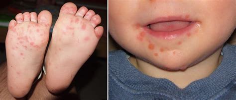 What Is Hand Foot And Mouth Disease 7 Questions With Cassie Amadio F