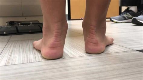 Pediatric Flatfoot Reconstruction Surgery Pediatric Foot And Ankle