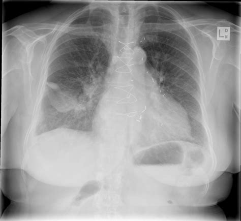 Pleural effusion is the term for fluid accumulation in the pleural space around the lungs. Radiografía torácica: Derrames pleurales - UpToMedicine