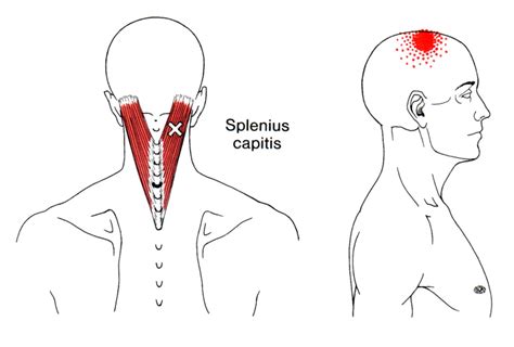 Splenius Capitis The Trigger Point And Referred Pain Guide