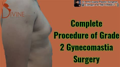 Complete Procedure Of Grade Gynecomastia Surgery Youtube