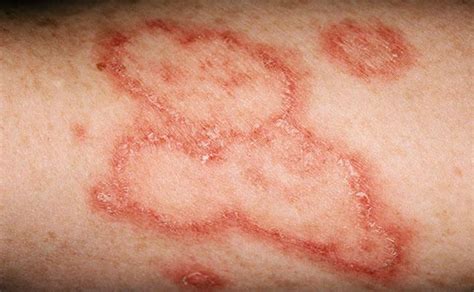 How to assess disease activity in patients with chronic urticaria? 9 Things You Need To Know About Lupus | Diagnosing lupus ...