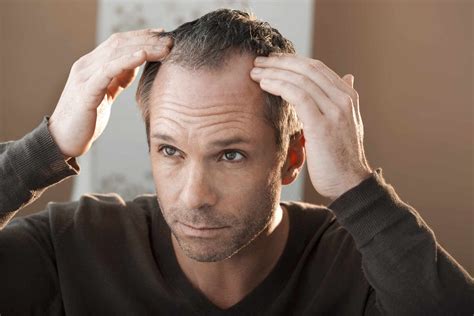 Male Pattern Baldness Treatment Utah Regeneration Health