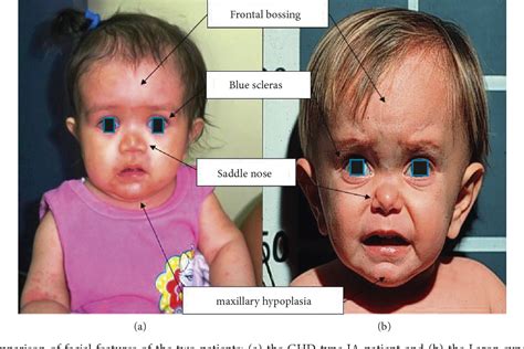 The manifestation of growth hormone deficiency depends upon the age of onset of the disorder and can result from either heritable or acquired disease. Figure 1 from Same Phenotype in Children with Growth ...