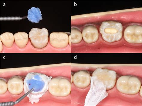 Rehabilitation Of The Occlusal Surface With A Resin Based Composite
