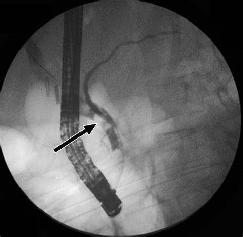 Laparoscopic Cholecystectomy Postoperative Imaging Ajr