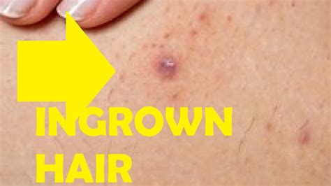 How To Get Rid Of An Ingrown Hair That Has Turned Into A Cyst Youtube